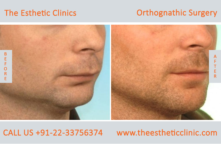 Orthognathic Surgery, Jaw Correction Surgery before after photos in mumbai india (4)